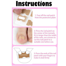 Load image into Gallery viewer, Ingrown Toenail Corrector Patches