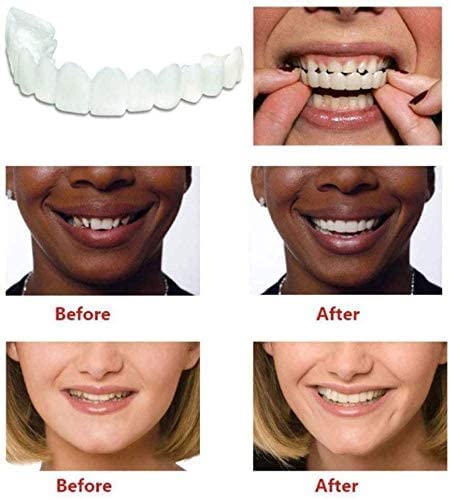 Smile Veneers - Adjustable Snap On Dentures - Doctors Recommended