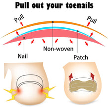 Load image into Gallery viewer, Ingrown Toenail Corrector Patches