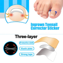 Load image into Gallery viewer, Ingrown Toenail Corrector Patches