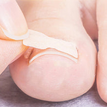 Load image into Gallery viewer, Ingrown Toenail Corrector Patches