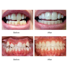Load image into Gallery viewer, Dental Aligner Braces- Orthodontic Teeth Alignment Brace Trainer
