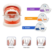 Load image into Gallery viewer, Dental Aligner Braces- Orthodontic Teeth Alignment Brace Trainer
