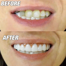 Load image into Gallery viewer, Snap On Dentures Kit - Perfect Smile Veneers (Upper &amp; Lower)
