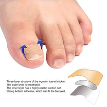 Load image into Gallery viewer, Ingrown Toenail Corrector Patches
