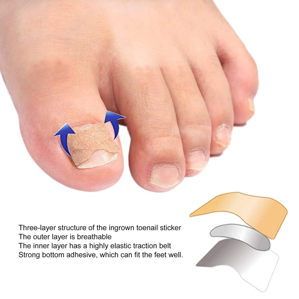 Ingrown Toenail Corrector Patches