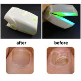 Portable Fungus Nail Laser