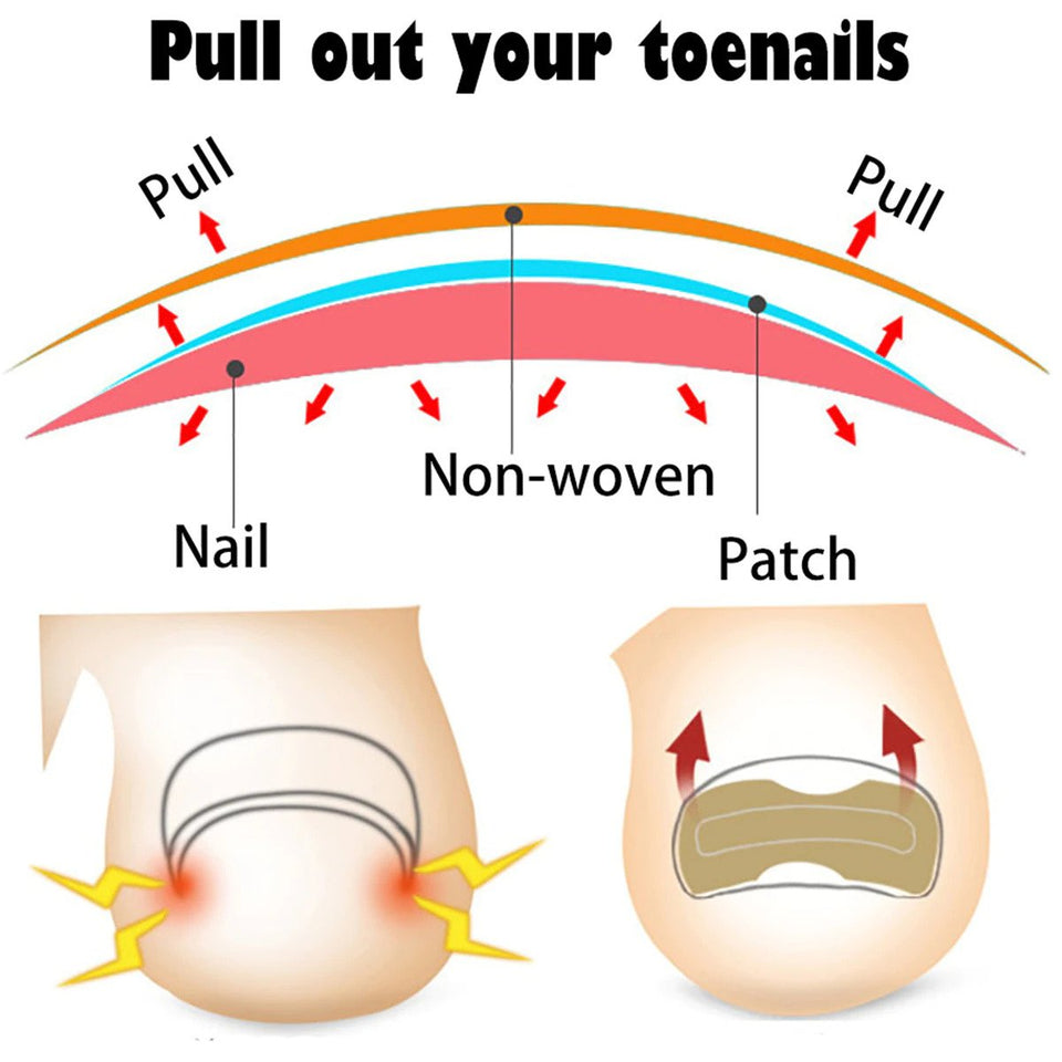 Ingrown Toenail Corrector Patches