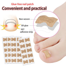 Load image into Gallery viewer, Ingrown Toenail Corrector Patches
